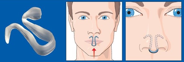 dilatateur-nasal-arreter-de-ronfler